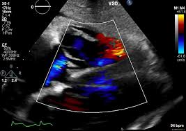 Echocardiography
